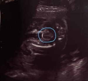 妊娠24週男の子エコー（コーヒー豆）