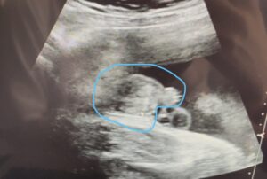 妊娠30週男の子エコー（陰茎・陰嚢とへその緒）